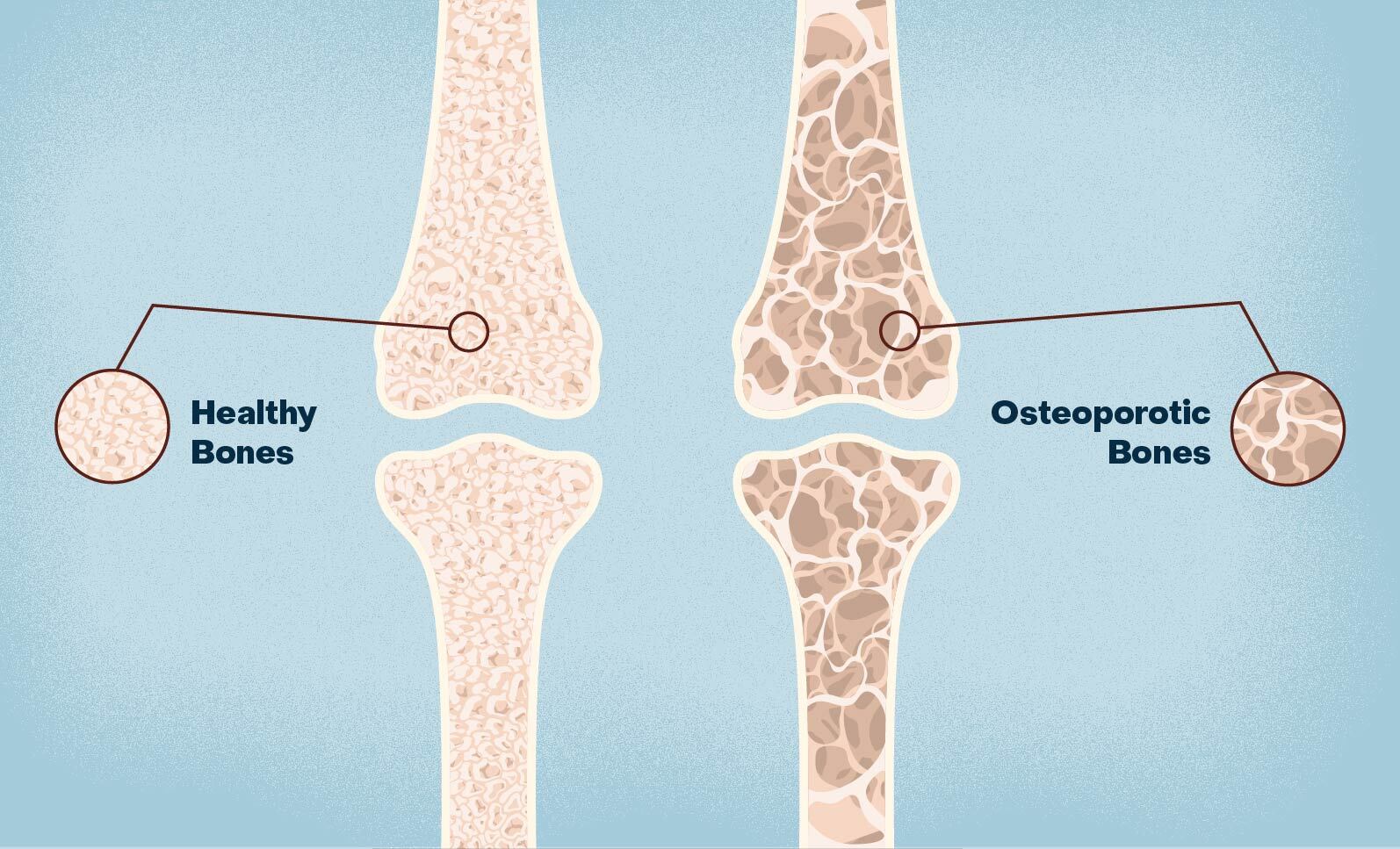 Bone Health / Osteoporosis