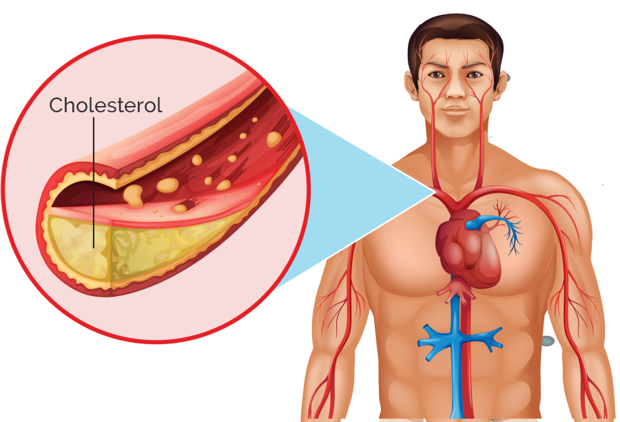 Cholesterol Related Disorders
